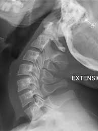 This procedure may be used to diagnose back or neck pain, fractures or broken bones, arthritis, degeneration of the disks, tumors, or other problems. Normal Flexion And Extension Cervical Spine X Rays Radiology Case Radiopaedia Org