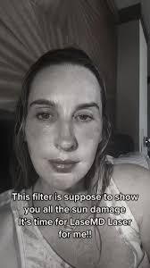 Masseter Reduction, or Jaw Reduction, is where the lower muscle of the face  termed the masseter muscle is reduced. The benefits of this can be two  fold....