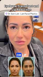 This 38-year-old woman gives a testimonial seven months after an eyebrow  hair transplant and surgical lip reduction. She had overplucked her  eyebrows when she was young, then had unnatural ...