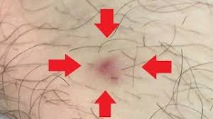 Uncategorized july 1, 2021 0 masuzi. Ingrown Hair Removal On Man S Leg Youtube