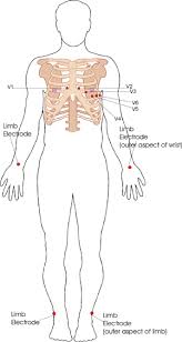 3 lead ecg placement of electrodes uk google search