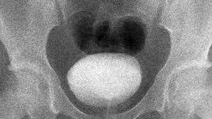 Any invasive exam/procedure can cause trauma. Voiding Cystourethrogram Vcug Children S Hospital Of Philadelphia