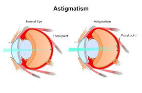 All sorts, from prescription contact lenses to disposables, corrective vision wear for astigmatism, and colored. What Are The Best Contact Lenses For Astigmatism