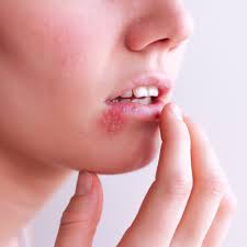 I have hsv2 genital, and somehow i think i've managed to get it around my mouth. Differences Between Hsv 1 And Hsv 2 Oral And Genital Herpes Allure