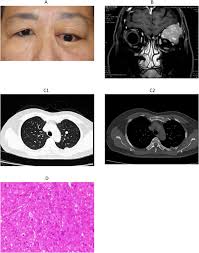 Image result for Leiomyosarcoma