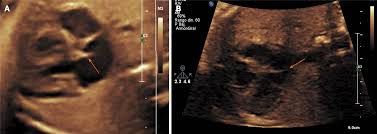 Prenatal diagnosis of cor triatriatum sinister associated with early  pericardial effusion: A case report