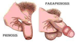 Image result for paraphimosis