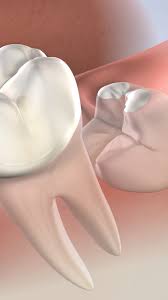 The teeth are easiest to extract and present the least complications up until the roots. Wisdom Teeth Removal In Springfield Il Third Molar Extraction