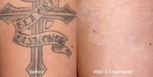Check spelling or type a new query. Laser Tattoo Removal Gentle Touch Medispa