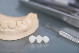 Dental Bridges