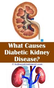 Kidney Disease Quotes Kidney Disease Kidney Disease Symptoms Polycystic Kidney Disease