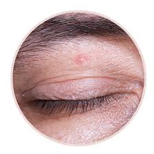 Image result for milium cyst on eyelid