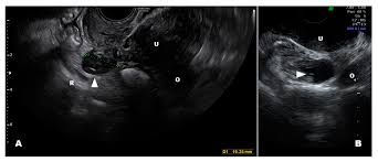 You could have only one, or you could have a cyst on each of your ovaries. Diagnostics Free Full Text Differential Diagnosis Of Endometriosis By Ultrasound A Rising Challenge Html