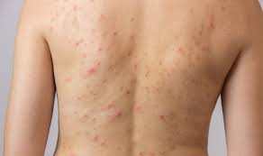 Acne En La Espalda Y Pecho Causas Y Tratamientos Naturales