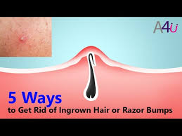 An ingrown hair can be identified as a small bump on the skin and may potentially be red, swollen, warm to the touch and painful. 5 Ways To Get Rid Of Ingrown Hair Or Razor Bumps By All For You Youtube