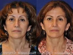 Top Facelift Doctors in Exeter, NH