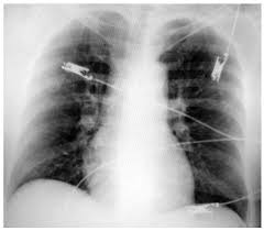 Maybe you would like to learn more about one of these? Diagnostico De Tromboembolia Pulmonar Archivos De Cardiologia De Mexico