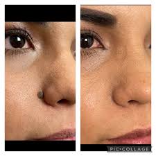 Mole Removal Albuquerque NM, D. Eric Tuggle, D.D.S.