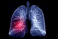 Lung cancer is incurable unless complete surgical removal of the tumour cells can be achieved. Covid 19 And Lung Cancer Have A Common Pathway Say Researchers