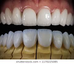 Dental Veneers Images Stock Photos Vectors Shutterstock