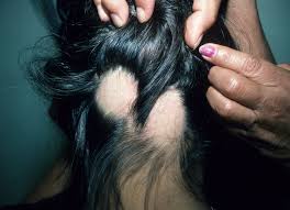 Hair loss due to alcohol consumption is mainly due to the fact that alcohol affects the levels of estrogen and zinc in the body, which subsequently affect hair growth. Bald Spots On Scalp Mdedge Family Medicine