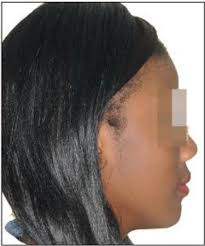 Treatment of a Class 2 biproalveolia in a patient of Burkinabe origin