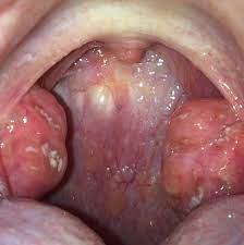 Risse In Mandeln Und Blasen Im Rachen Gesundheit Und Medizin Mund
