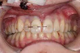Image result for Tooth Luxation