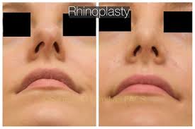 Rhinoplasty Rhinoplasty Facial Plastic Rhinoplasty Surgery