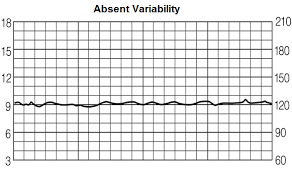 Fetal Heart Rate Variability