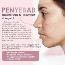 Jerawat pasir adalah jerawat dengan ukuran sangat kecil dalam jumlah banyak. Ms Glow Red Jelly Msglow Krim Jerawat Krim Flek Krim Extra Glowing Shopee Indonesia