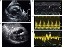 Image result for Pericarditis