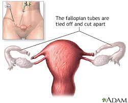 Tubal Ligation Edmonton Sun