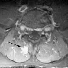 Microscopic anatomy of skeletal muscle. Anatomy Of The Intrinsic Back Muscles Line Diagram Of Axial Section At Download Scientific Diagram