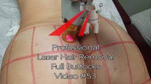 Patients should shave within 12 hours. Professional Laser Hair Removal Full Buttocks Video 53 Youtube