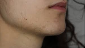 Marta's electrolysis provides quality electrolysis treatment procedures that'll make your facial hair a thing of the past. Update 1 Facial Hair Electrolysis Vs Laser Hair Removal Pcos Youtube