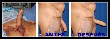 Oct 15, 2018 · a faloplastia é uma cirurgia que tem dois objetivos distintos: Dr Alberto Lajo Rivera Faloplastia