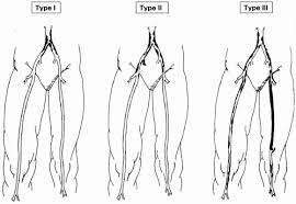 Aortoiliac Occlusive Disease North Texas Vascular Center
