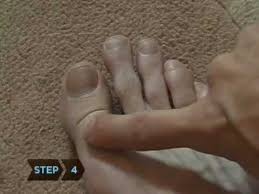 She was admitted to hospital with _____ of both legs. How To Know If Your Toe Is Broken Youtube