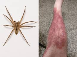 Image result for Spider Bite