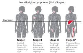 It can also form in the lymph nodes and other organs, such as the stomach, intestines, and skin. Nhl Staging Leukemia And Lymphoma Society