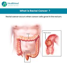 Rectal cancer treatment options include surgery, radiation therapy, chemotherapy, targeted therapy, and active surveillance. Rectal Cancer Don T Ignore The Early Signs Healthsoul