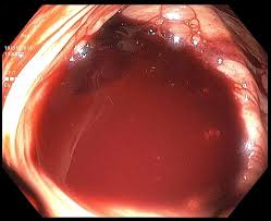 Image result for Colonoscopy in GI Bleeding
