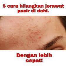 53 likes · 3 talking about this. Stress Jerawat Pasir Penuh Kat Dahi Jom Ikut Tips Ni Health Beauty Face Skin Care On Carousell