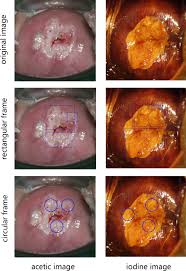 Image result for Colposcopy Findings