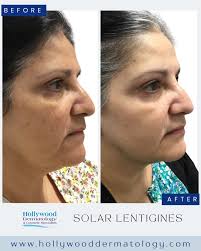 Do you have sun spots that just won't fade? 🤔 Target them at the source  with our customized Hydroquinone treatments for solar lentigines—expertly  performed by PA-C Lidice Lopez @lidice_lopez_pa. These real results