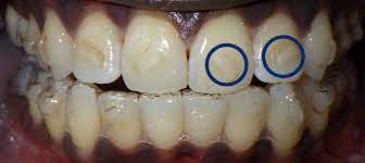We did not find results for: What Are Invisalign Attachments Everything You Need To Know