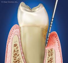 Understanding Periodontal Pockets