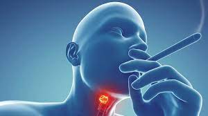 The vocal cords vibrate together when air passes between them. Persistent Sore Throat Can Be Cancer Sign Bbc News