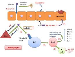 Celiac disease usually manifests in childhood with diarrhea, weight loss and failure to thrive. The Role Of Th1 And Th17 In The Pathogenesis Of Celiac Disease Medcrave Online